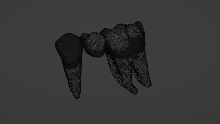 Fixed partial denture - Prosthodontics 3D model_6