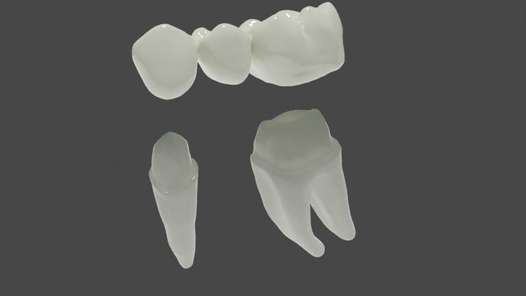 Fixed partial denture - Prosthodontics 3D model_1
