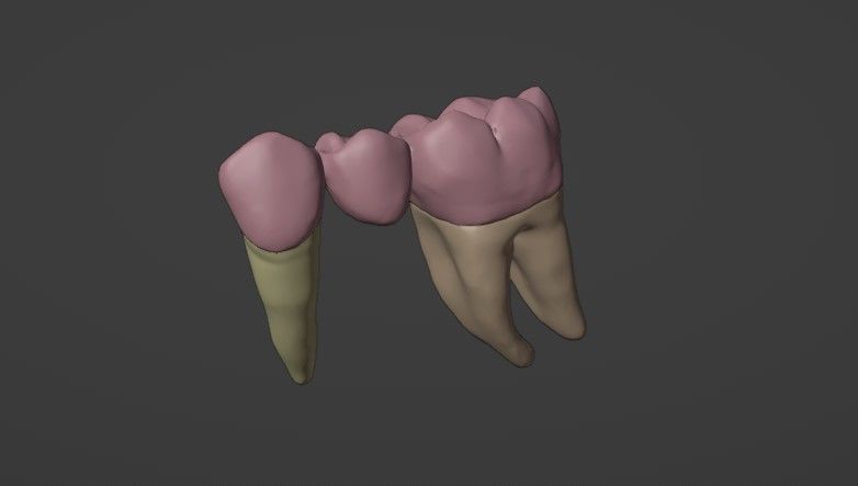 Fixed partial denture - Prosthodontics 3D model_5