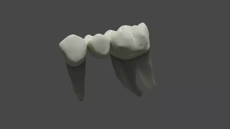 Fixed partial denture - Prosthodontics 3D model_0