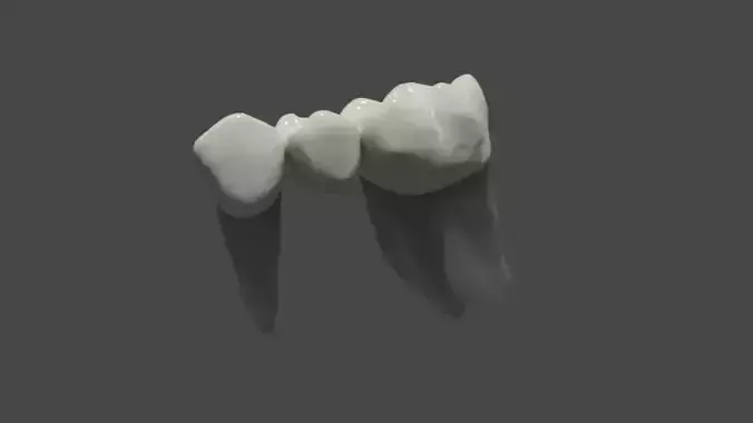 Fixed partial denture - Prosthodontics