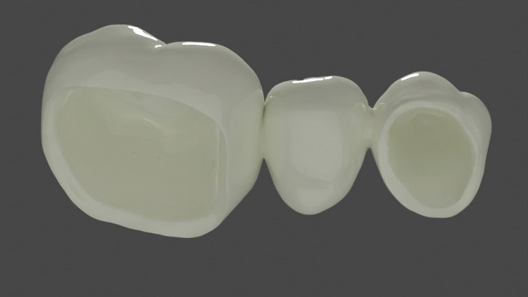 Fixed partial denture - Prosthodontics 3D model_3