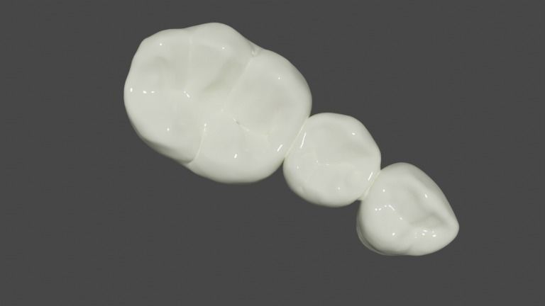 Fixed partial denture - Prosthodontics 3D model_4