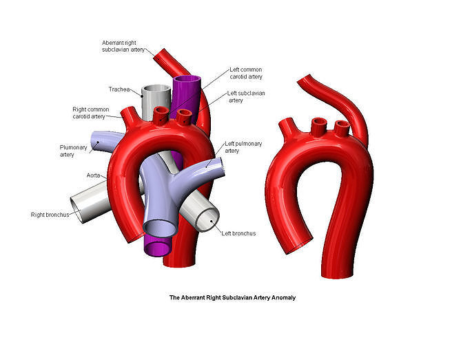  Aberrant right subclavian artery anomaly 3D print model