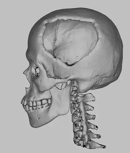 My Skull defect from car accident STL from CT Scan data