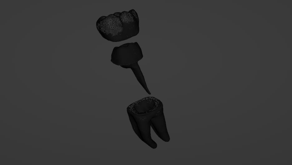 Fiber post and core with single crown - Posterior tooth 3D model_5