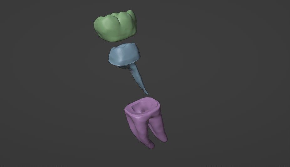 Fiber post and core with single crown - Posterior tooth 3D model_6