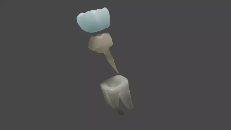 Fiber post and core with single crown - Posterior tooth 3D model_0