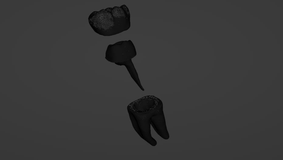 Metal cast post with single crown - Posterior tooth 3D model_6