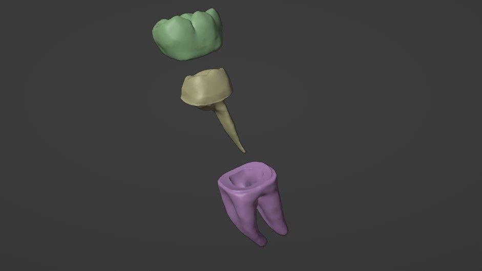Metal cast post with single crown - Posterior tooth 3D model_7