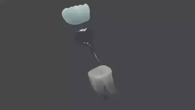 Metal cast post with single crown - Posterior tooth 3D model