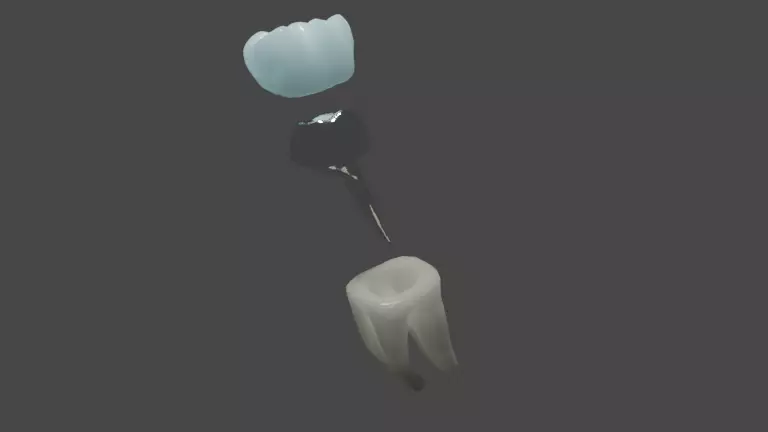 Metal cast post with single crown - Posterior tooth 3D model_0