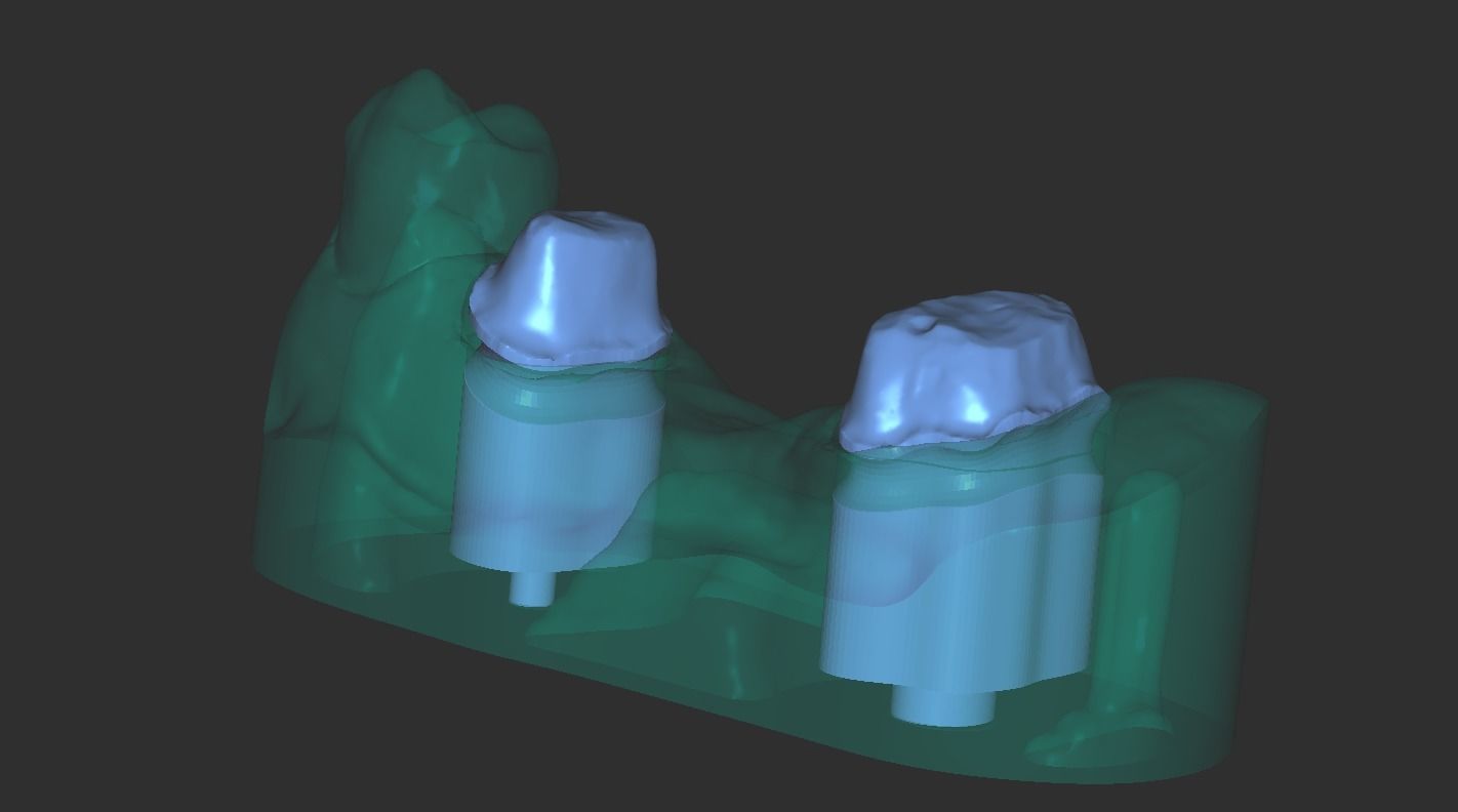 Digital Full Contour Bridge and Model 3D print model_20