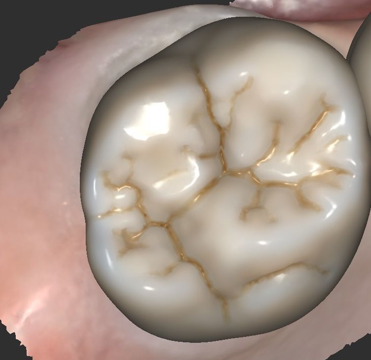 Digital Full Contour Bridge and Model 3D print model_8
