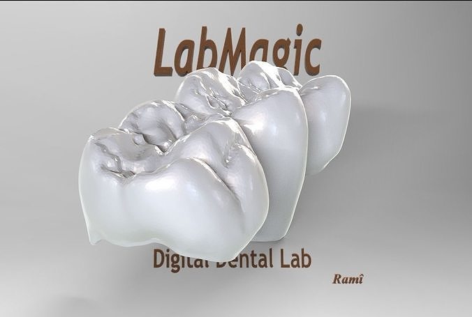 Digital Full Contour Bridge and Model 3D print model