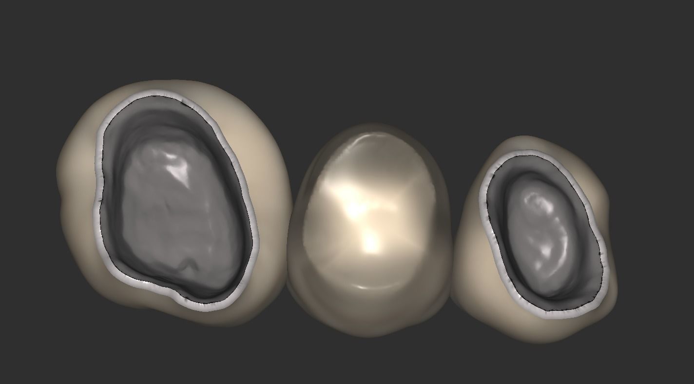 Digital Full Contour Bridge and Model 3D print model_13