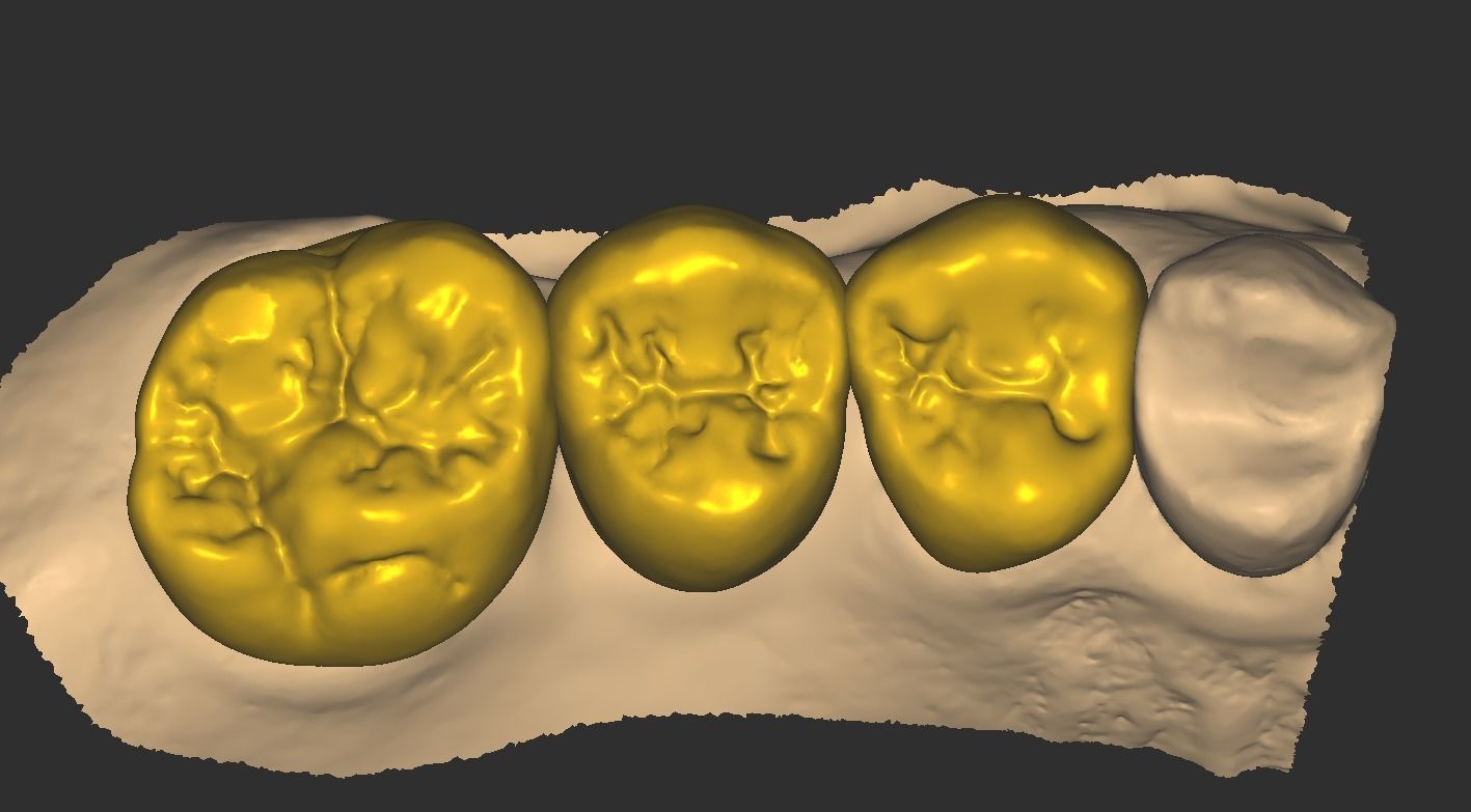 Digital Full Contour Bridge and Model 3D print model_21