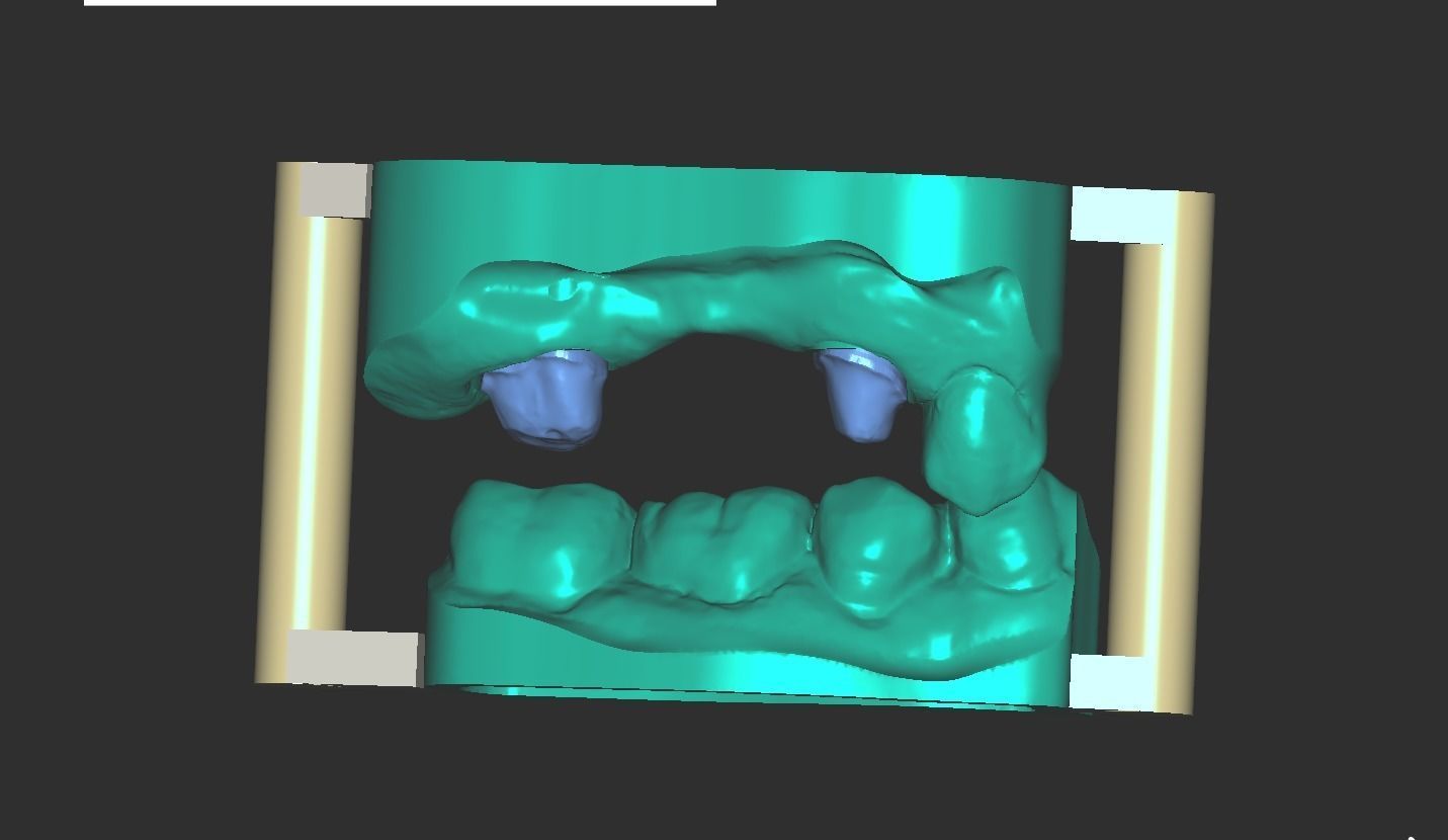 Digital Full Contour Bridge and Model 3D print model_15