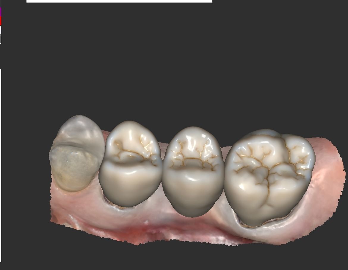 Digital Full Contour Bridge and Model 3D print model_16