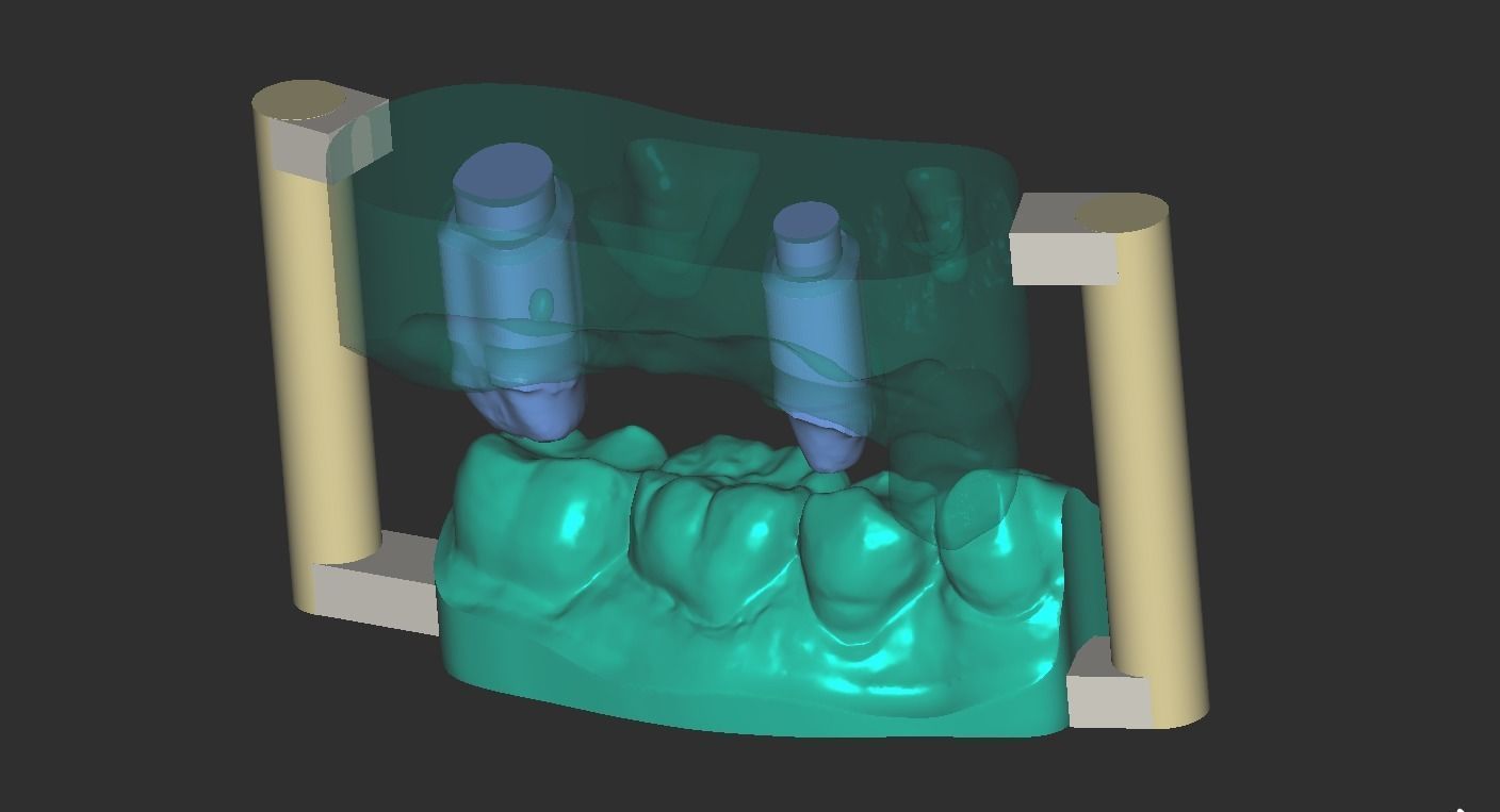 Digital Full Contour Bridge and Model 3D print model_17