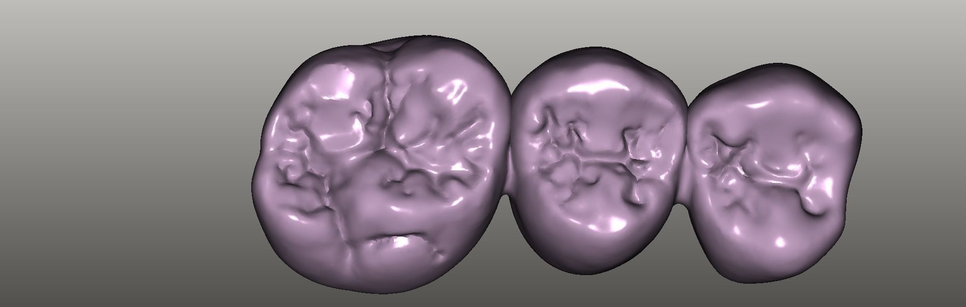 Digital Full Contour Bridge and Model 3D print model_12