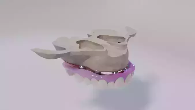 Full arch fixed implant-supported prostheses - Dental implant 3D model