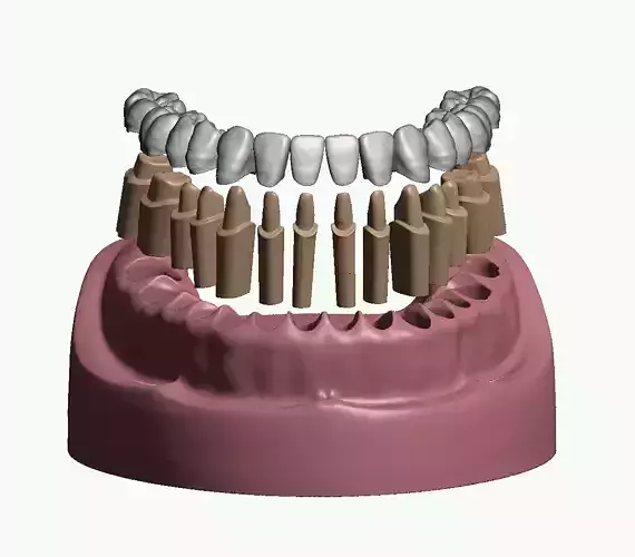 Mandibular dental model prepped dies and crowns
