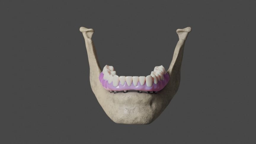 Full arch fixed implant-supported prostheses - Lower arch 3D model_1