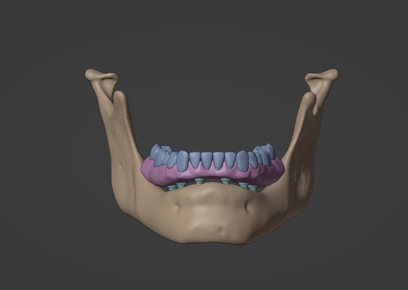 Full arch fixed implant-supported prostheses - Lower arch 3D model_9