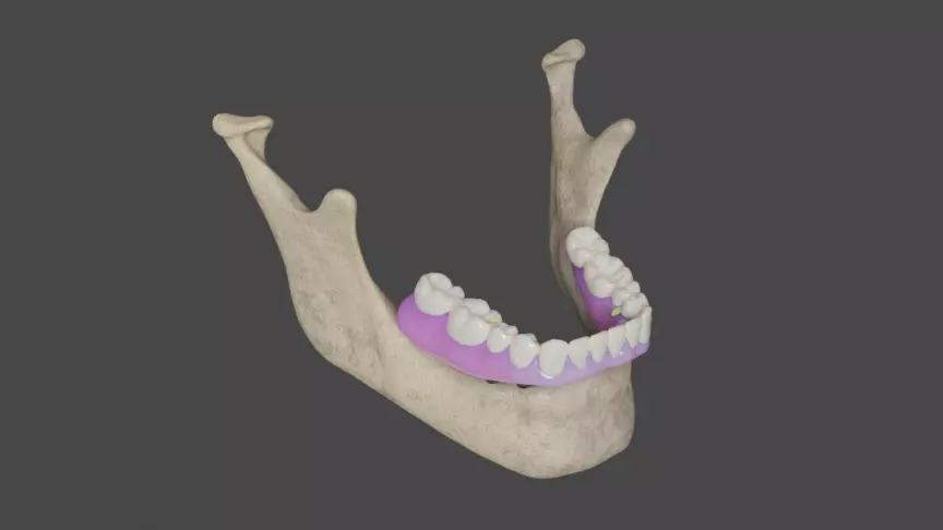 Full arch fixed implant-supported prostheses - Lower arch 3D model_0