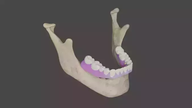 Full arch fixed implant-supported prostheses - Lower arch