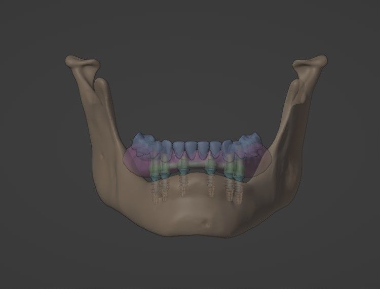 Full arch fixed implant-supported prostheses - Lower arch 3D model_8