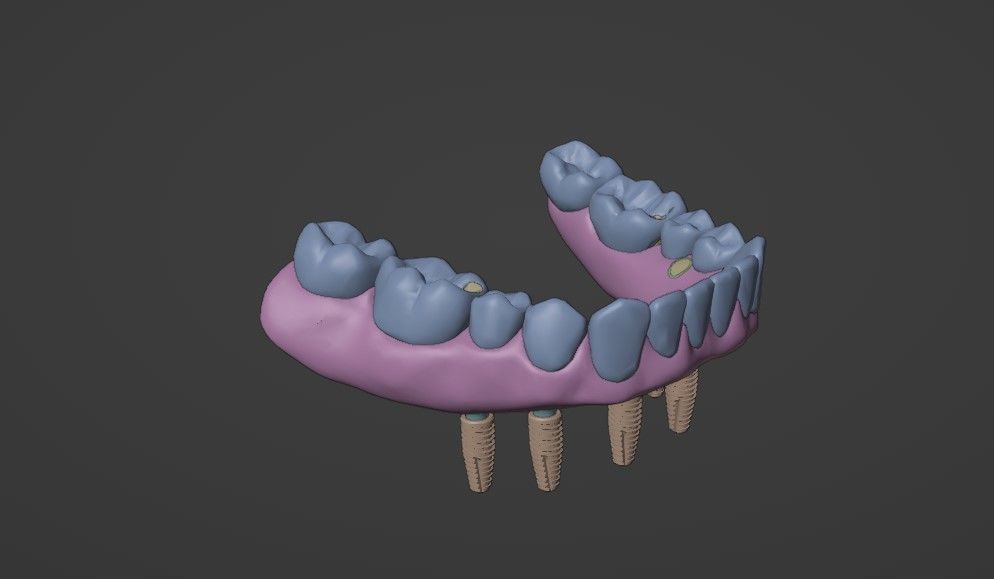 Full arch fixed implant-supported prostheses - Lower arch 3D model_6