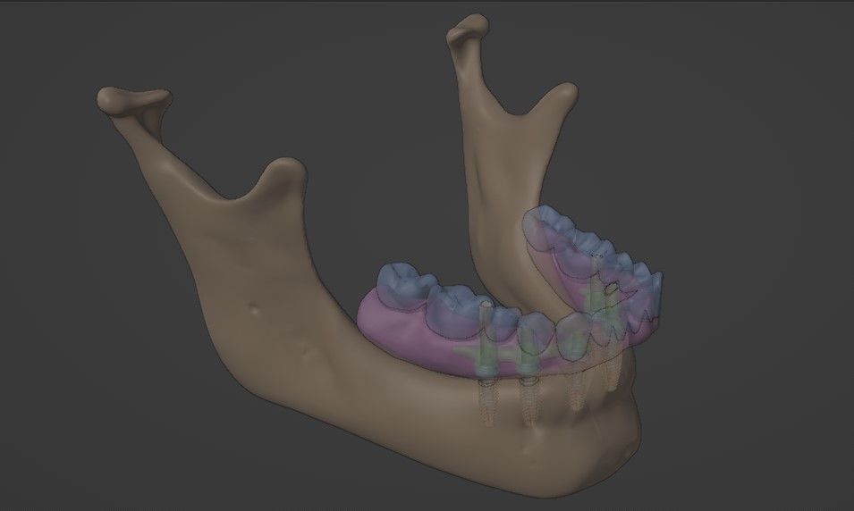 Full arch fixed implant-supported prostheses - Lower arch 3D model_7