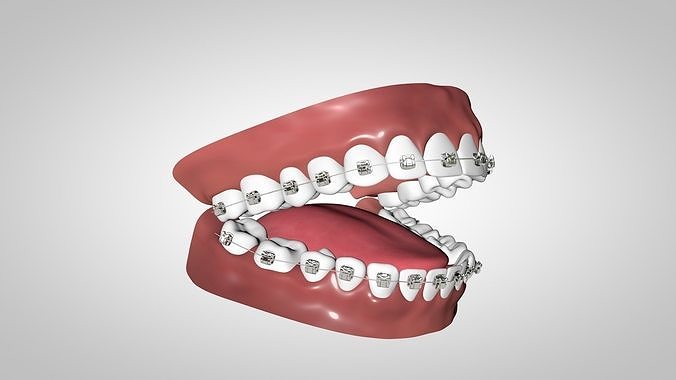 Dental Braces with Metal and Self Ligating brackets Low-poly 3D model