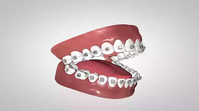 Dental Braces with Metal and Self Ligating brackets
