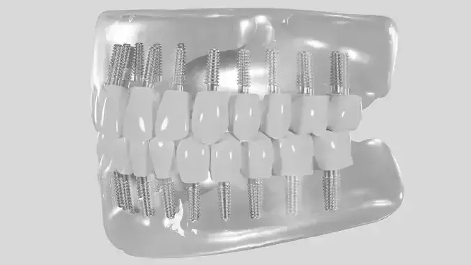 Dental implant 3D model