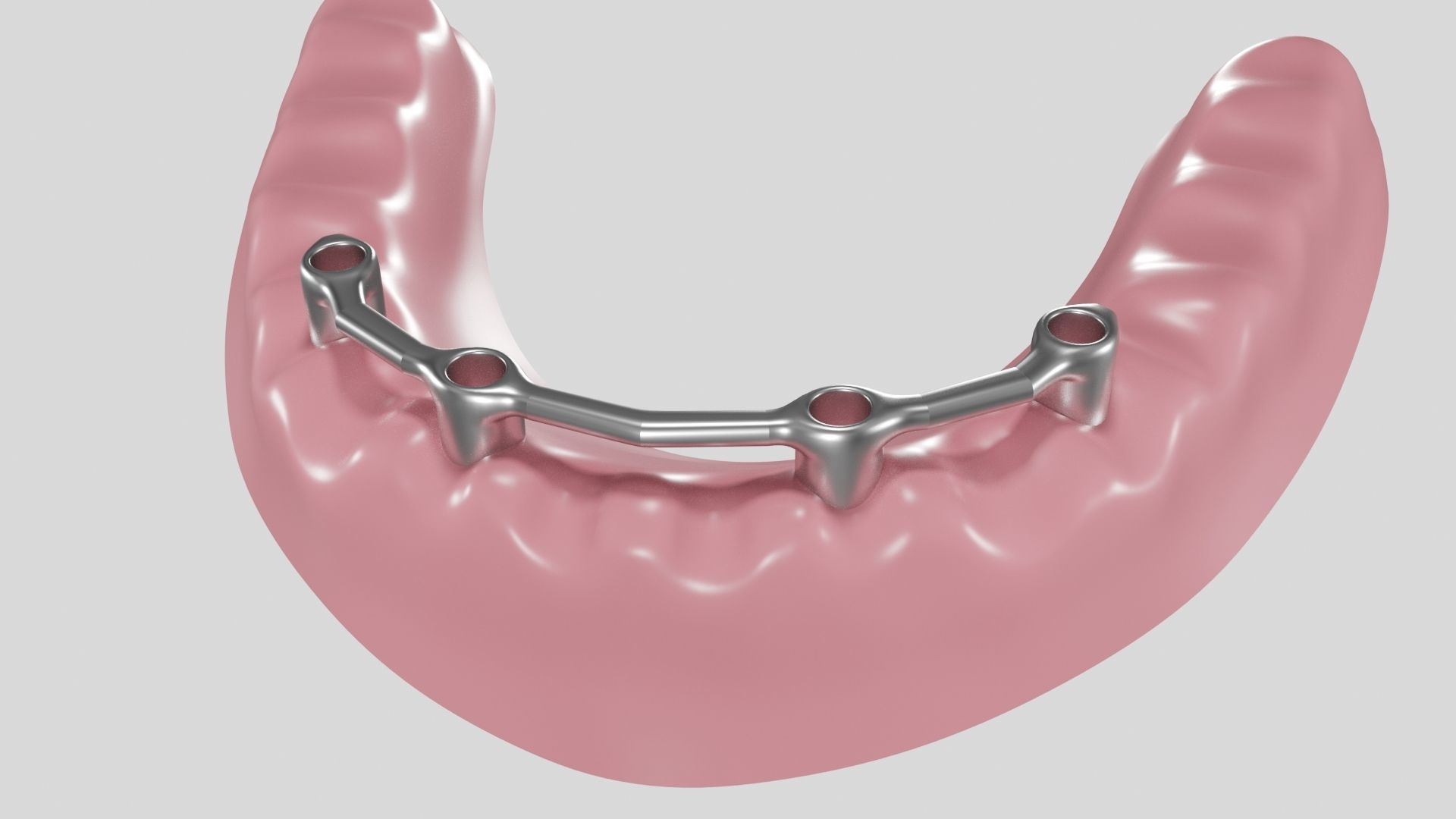Hibrid implant bar attachment 3D model_5