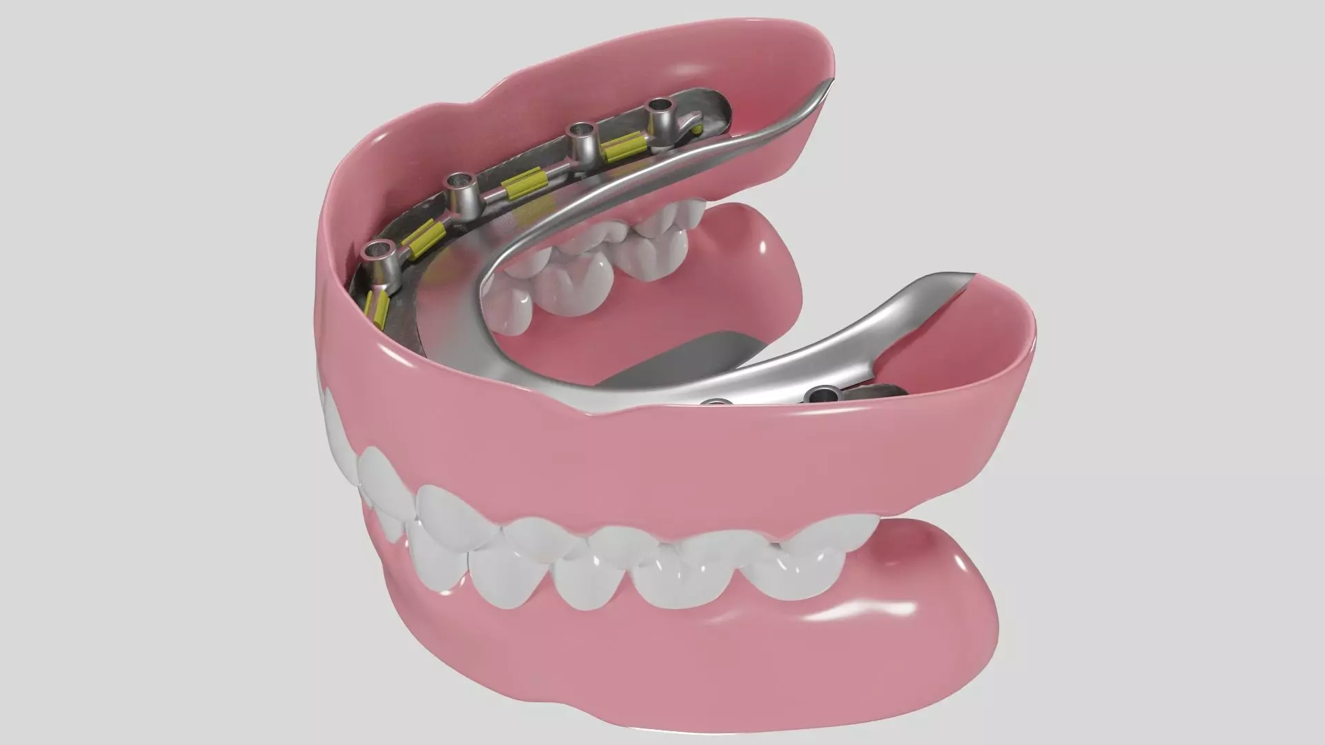 Hibrid implant bar attachment 3D model_0