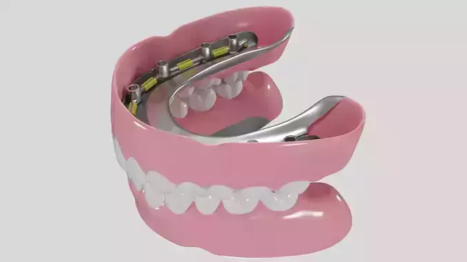 Hibrid implant bar attachment 3D model