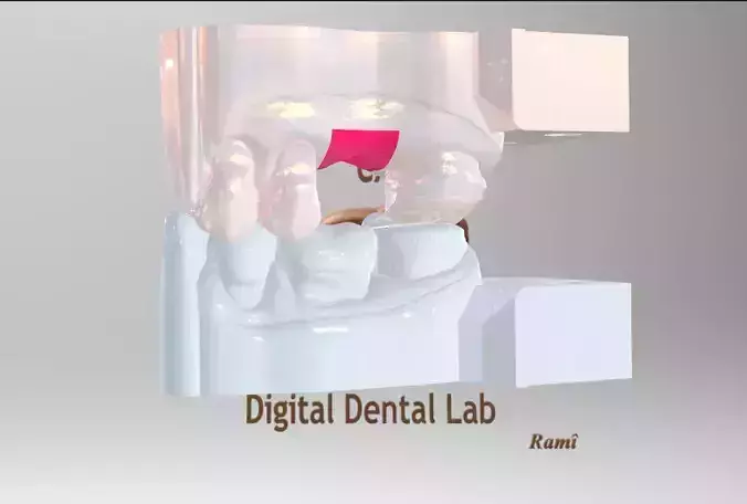 Digital Ti-Base Abutment Model