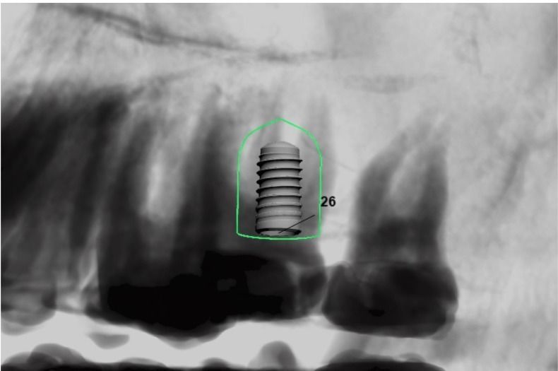 Digital Surgical Guide  3D print model_3