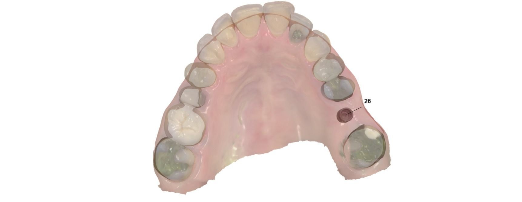 Digital Surgical Guide  3D print model_7
