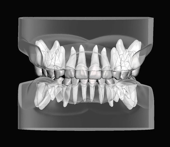 Pediatric dental model with individual teeth 3D print model