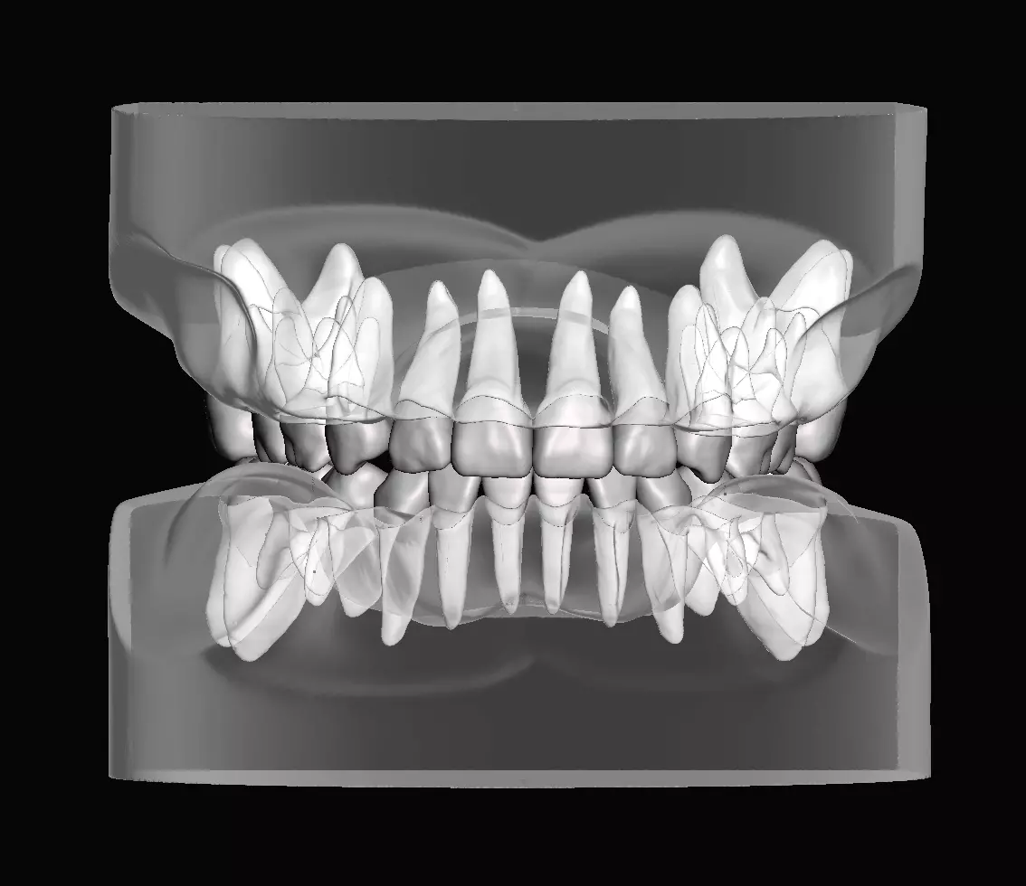 Pediatric dental model with individual teeth 3D print model_0