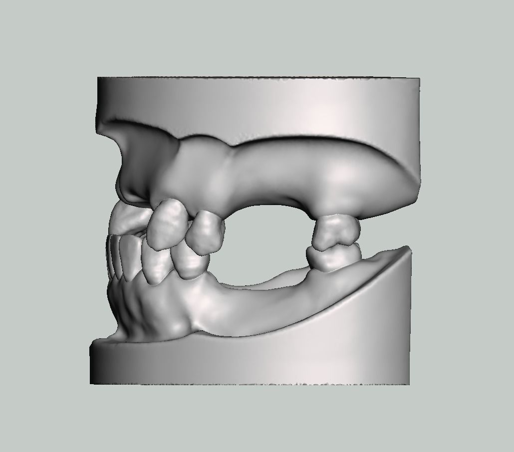 Partial edentulous model solid type upper lower 3D print model_2