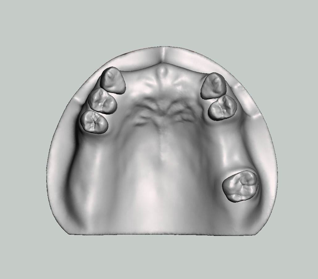 Partial edentulous model solid type upper lower 3D print model_3