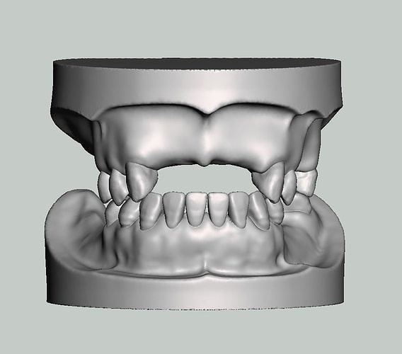 Partial edentulous model solid type upper lower 3D print model