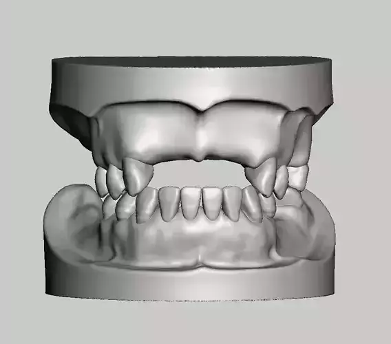 Partial edentulous model solid type upper lower 3D print model