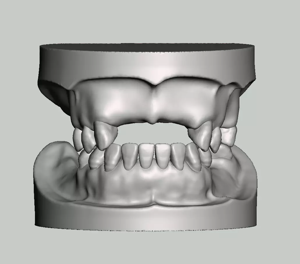 Partial edentulous model solid type upper lower 3D print model_0